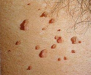 humani papiloma virus na koži