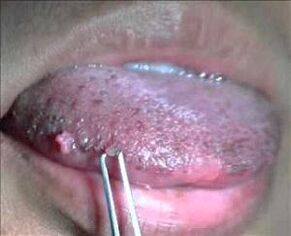 ljudski papiloma virus na jeziku