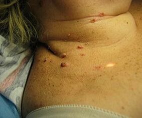 ljudski papiloma virus na vratu