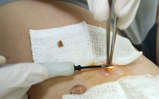 kirurško liječenje humanog papiloma virusa