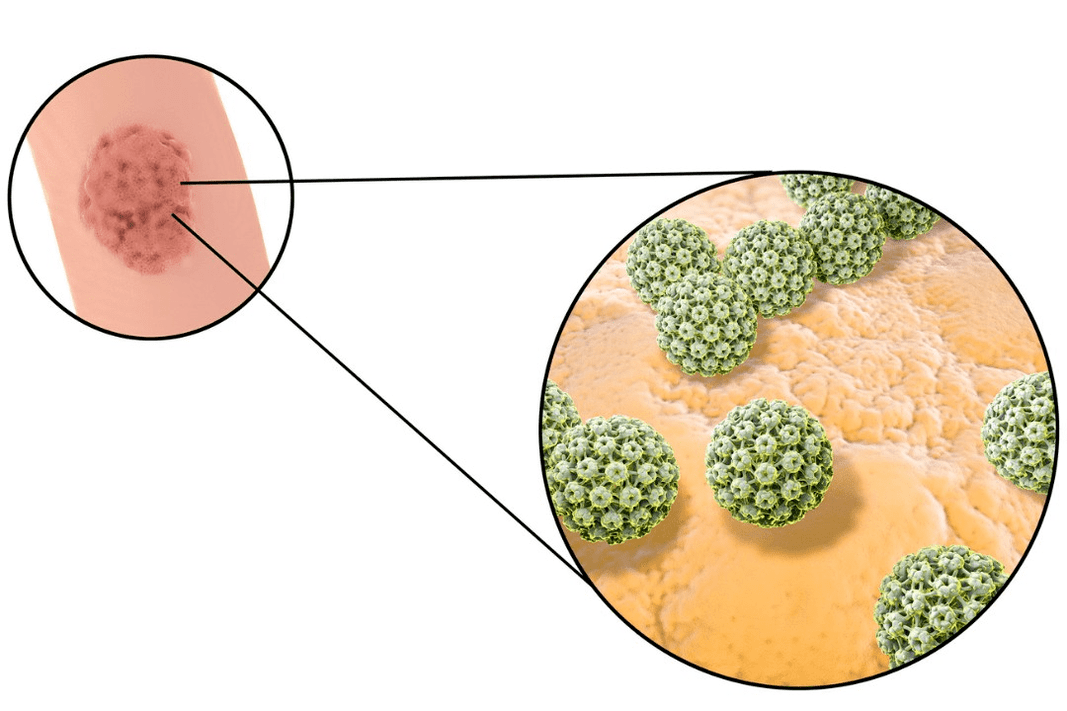 izvor infekcije papiloma skvamoznih stanica