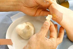 Liječenje papiloma oblogom od češnjaka
